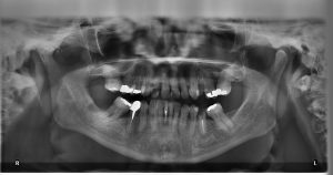 Pont32 fogászati röntgen